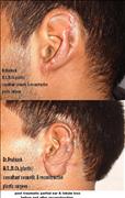 Before After Pictures,Cosmetic surgery,Delhi,ear reconstruction 